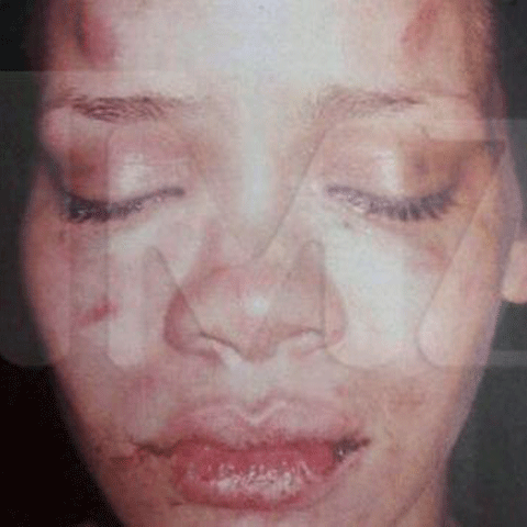 Primele poze cu Rihanna bătută