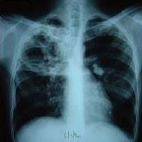 Obezitatea şi fumatul duc în egală măsură la deces, potrivit unui studiu 