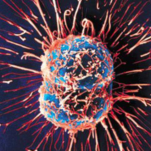 Grupele de sânge ar putea indica riscul de cancer pancreatic, potrivit unui studiu