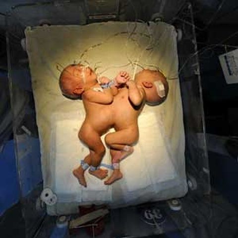 Doi gemeni siamezi au fost separaţi cu succes în China - VEZI GALERIE
