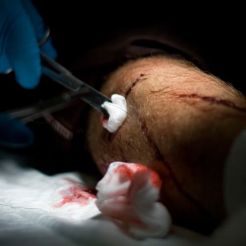 Operaţie în premieră mondială cu grefe de piele pentru faţă şi mâini, în Franţa