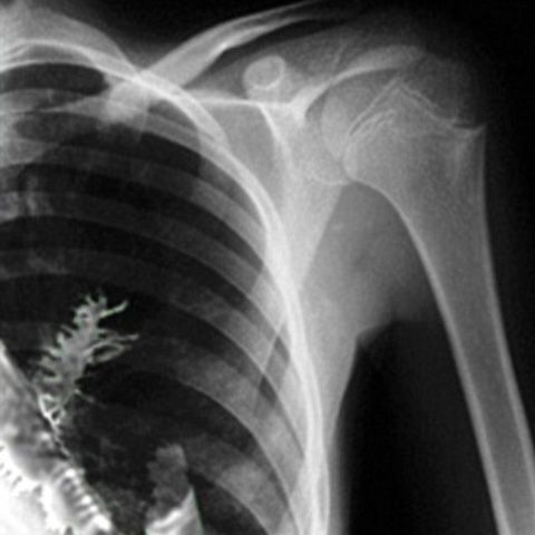 Un pacient rus a trăit cu un brad de cinci centimetri în plămân 