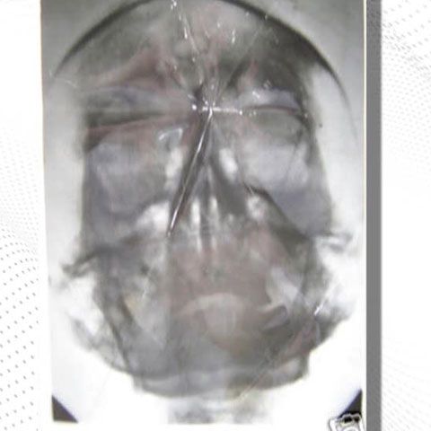 Un american a scos la licitaţie 2 radiografii craniene ale lui Hitler 