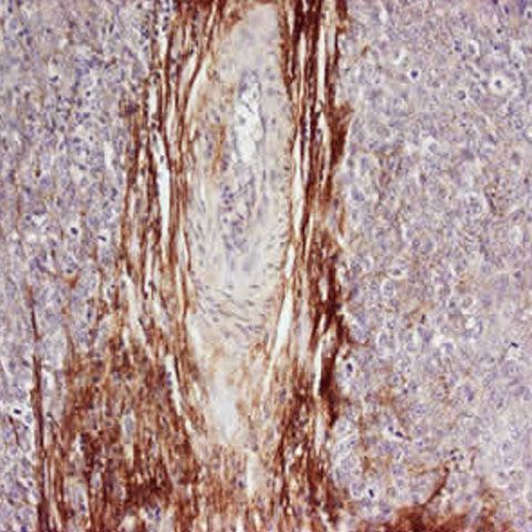 Osteopontina, responsabilă pentru apariţia bolilor pulmonare la fumători 