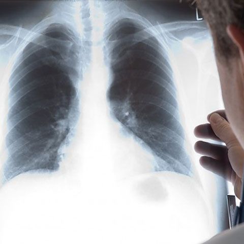 Un nou medicament pentru pacienţii cu insuficienţă respiratorie a fost lansat în România