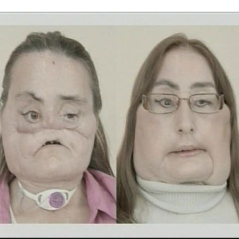 O femeie care a suferit un transplant facial s-a prezentat în faţa opiniei publice - IMAGINI ŞOCANTE