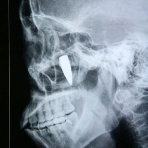 O chinezoaică a supravieţuit cu un glonţ în cap 42 de ani - FOTO