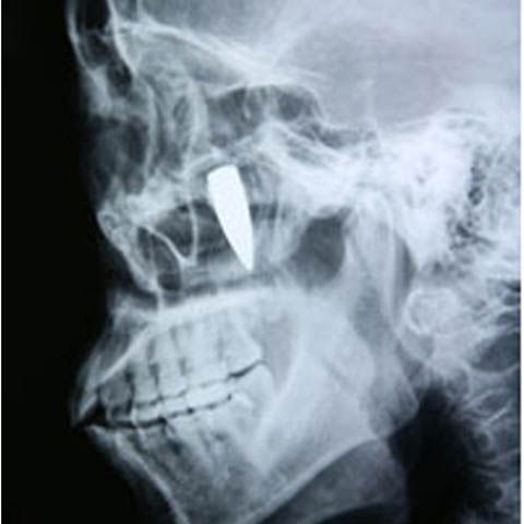 O femeie din China a trăit 42 de ani cu un glonţ în faţă