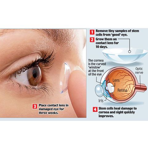 Australienii au testat cu succes lentilele de contact cu celule stem care ajută la refacerea corneei