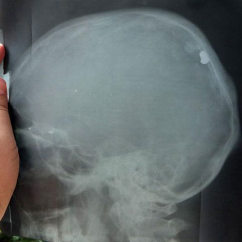 Un bărbat din Croaţia a trăit timp de 38 de ani cu un glonţ în cap