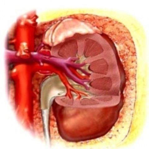 Un bărbat din Bucureşti are cinci rinichi