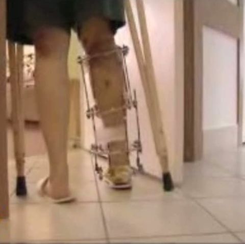 Pacientele unei clinici din Rusia plătesc 16.000 de lire sterline pentru a-şi lungi picioarele