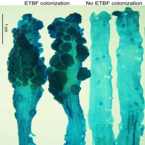 A fost descoperită bacteria care este responsabilă de cancerul la colon