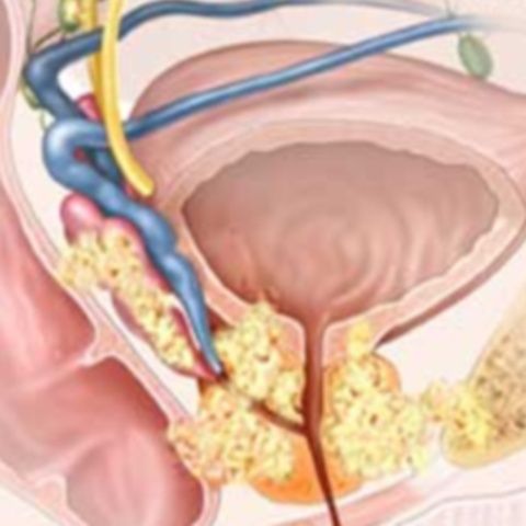 Cancerul de prostată ar putea fi provocat de un virus