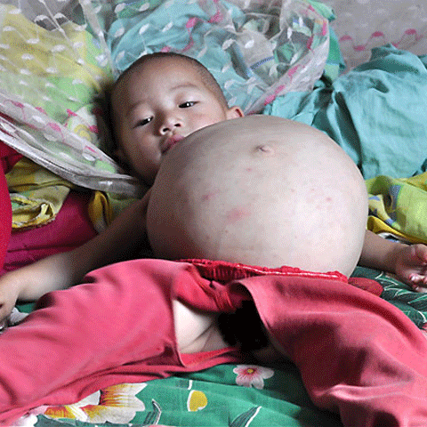 O fetiţă de un an l-a purtat în pântece pe fratele ei geamăn