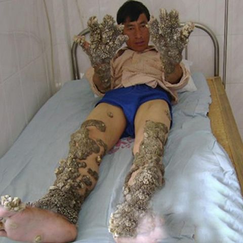 Omul-coral a început să scape de carapace