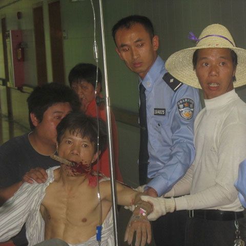 Un chinez a ajuns la spital cu o bară străpungându-i obrazul. ATENŢIE, IMAGINI ŞOCANTE!