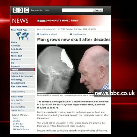 Unui britanic i s-a refăcut craniul distrus într-un accident 