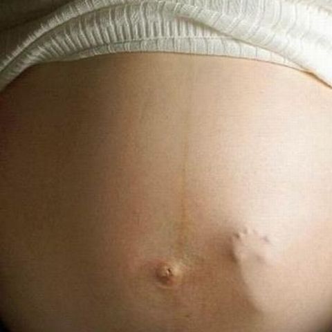 Avorturile nesigure ucid 70.000 de femei anual