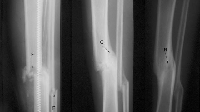 Premieră medicală la Bucureşti: o tânără va putea să meargă din nou, după 12 ani