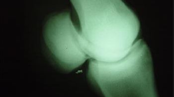 Un nou tratament inovator pentru artroză, cu proteine din sângele pacientului, disponibil în România