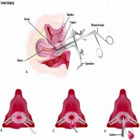 Cancerul cervical ar putea avea acelaşi tratament ca şi osteoporoza sau cancerul la sân