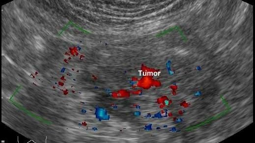 Marea Britanie a respins medicamentul destinat bolnavilor de cancer intestinal