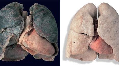 Fumătorii îşi pot calcula vârsta plămânilor