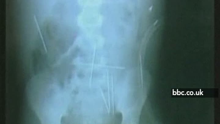 Brazilia: Un copil, victimă a magiei negre, trăieşte cu 40 de ace înfipte în corp