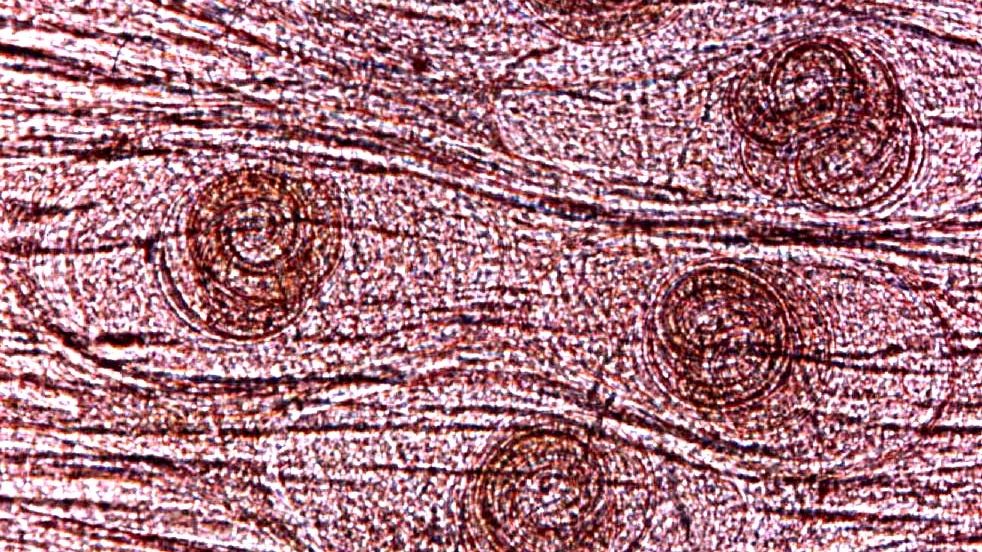 Au apărut primele cazuri de trichineloză în Bistriţa