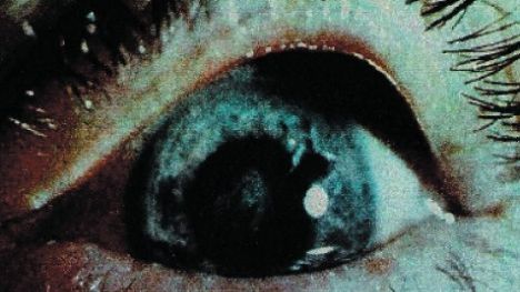 Vedere High Definition cu un nou tip de implant ocular