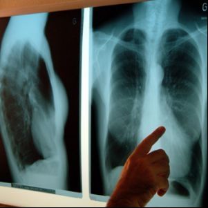 Pacienţii din Covasna deserviţi de doar doi radiologi