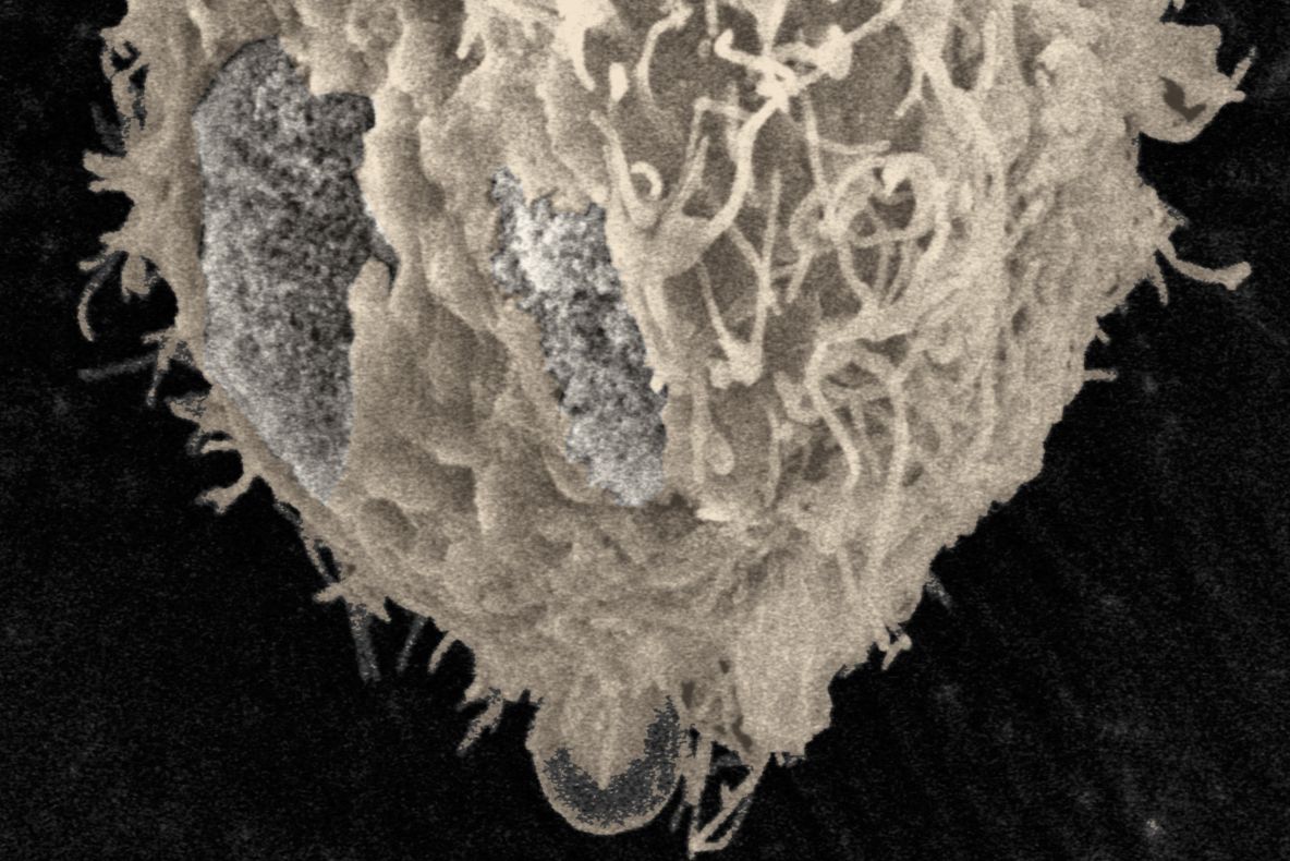 Cercetătorii americani au descoperit un anticorp care distruge celulele cancerului de prostată