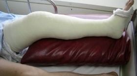 Tragedie la Cluj. Un bărbat a murit după o banală fractură. Familia acuză medicii