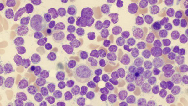 Semne de alarmă care anunță leucemia. Mare atenţie la aceste simptome!