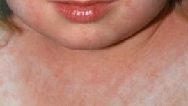 Epidemie de scarlatină şi oreion, în Suceava