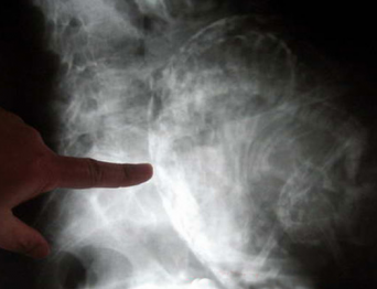 Femeia care a ULUIT medicina. A ţinut un făt în pântece timp de 60 de ani 