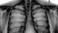 Radiografie ULUITOARE! Medicii au rămas FĂRĂ CUVINTE după ce au văzut asta