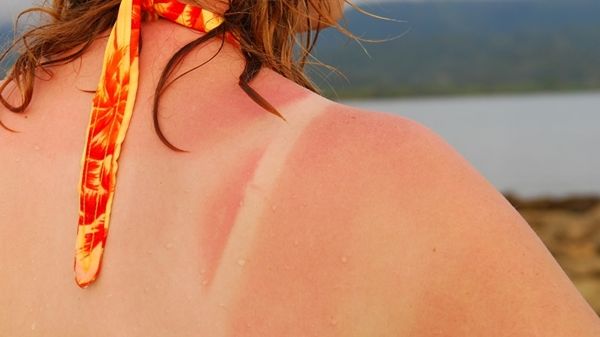 Simptomele care anunţă apariţia cancerului de piele