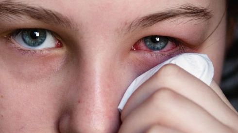 Şi-a acoperit pleoapele cu comprese din ceai de muşeţel, timp de 10 minute. Efectul a fost uimitor