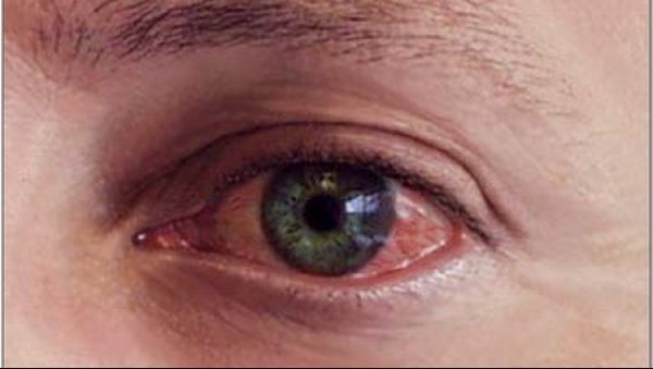 Şi-a cumpărat lentile de contact de pe net. Acum, medicii încearcă să îi salveze vederea