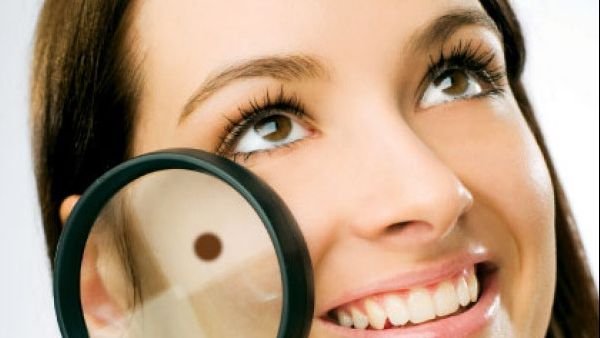 Ai alunițe pe față? Vezi ce semnificație au