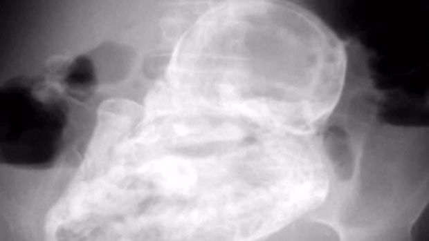 O femeie de 92 de ani din Chile purta de 50 de ani un fetus mumificat 