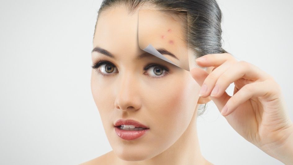 Leac din străbuni pentru coşuri şi acnee