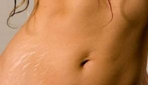 Metode prin care putem scăpa de vergeturi. Efectele se vor vedea imediat