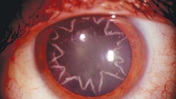 Cum arată ochii unui electrician după ce a fost curentat la 14.000 de volți