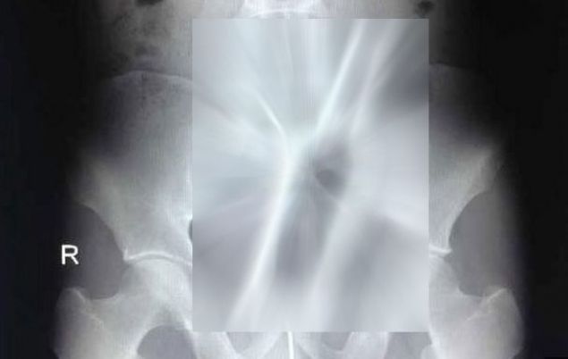 A mers la doctor cu dureri atroce, medicii au ramas ŞOCAŢI când au văzut ce are în burtă