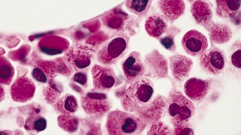 Semne de alarmă care anunță leucemia. Mare atenţie la aceste simptome!