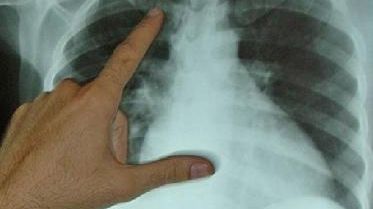 PROFESOR CU TBC: Sute de elevi din Gorj, duşi la analize