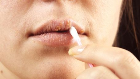 Cum să ții herpesul sub control cu remedii naturale